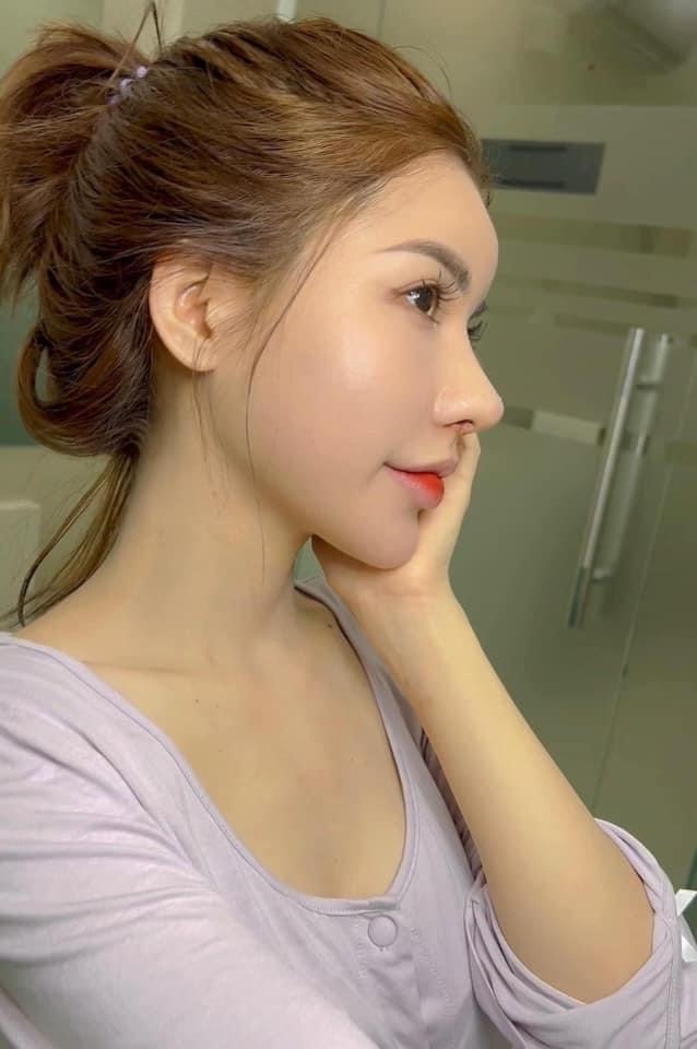 Hình ảnh khách hàng nâng mũi thẩm mỹ