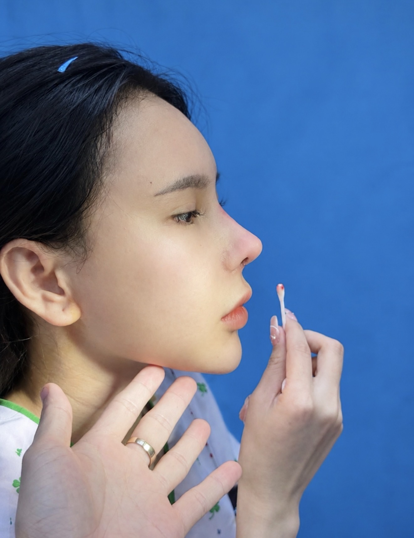 Nâng mũi (Nâng mũi Bán cấu trúc - Nâng mũi Cấu trúc)