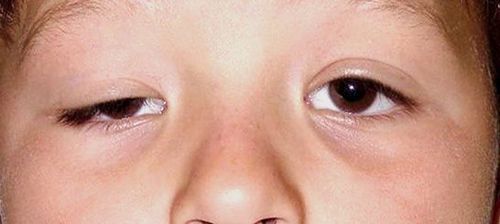 Điều trị sụp mi bẩm sinh tại Hải Phòng