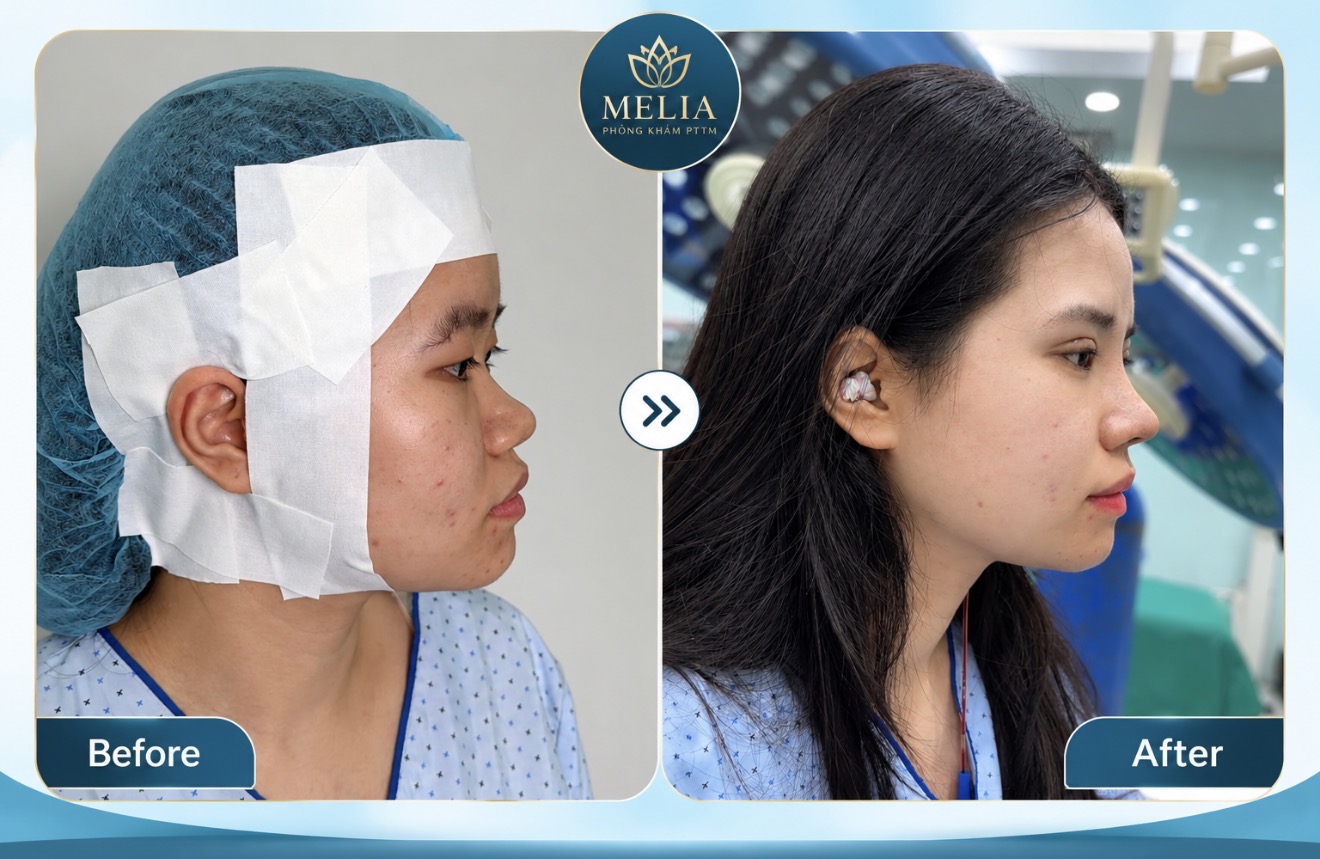 Phẫu thuật thẩm mỹ tại Hải Phòng – Hình ảnh khách hàng trước và sau