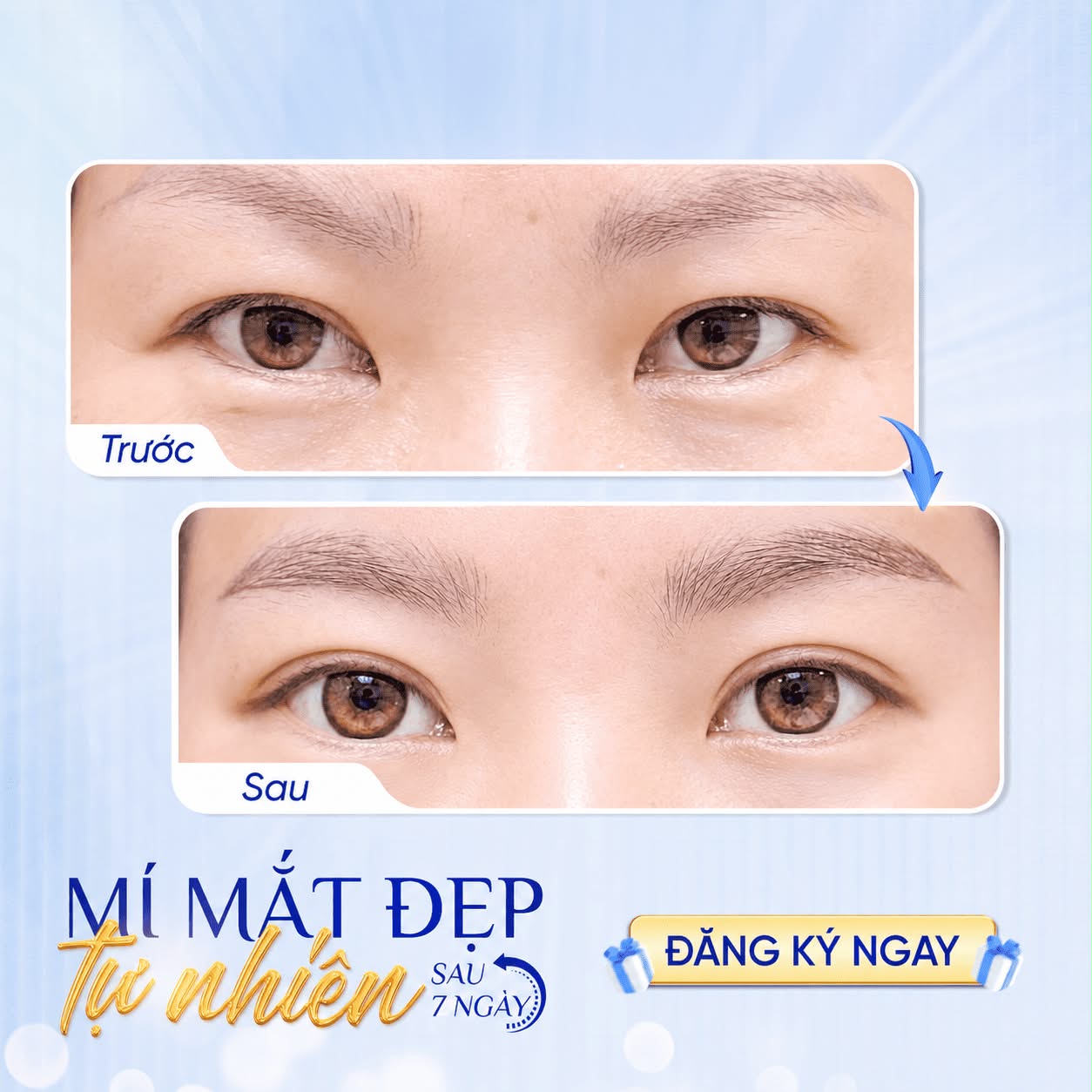 THẨM MỸ MẮT