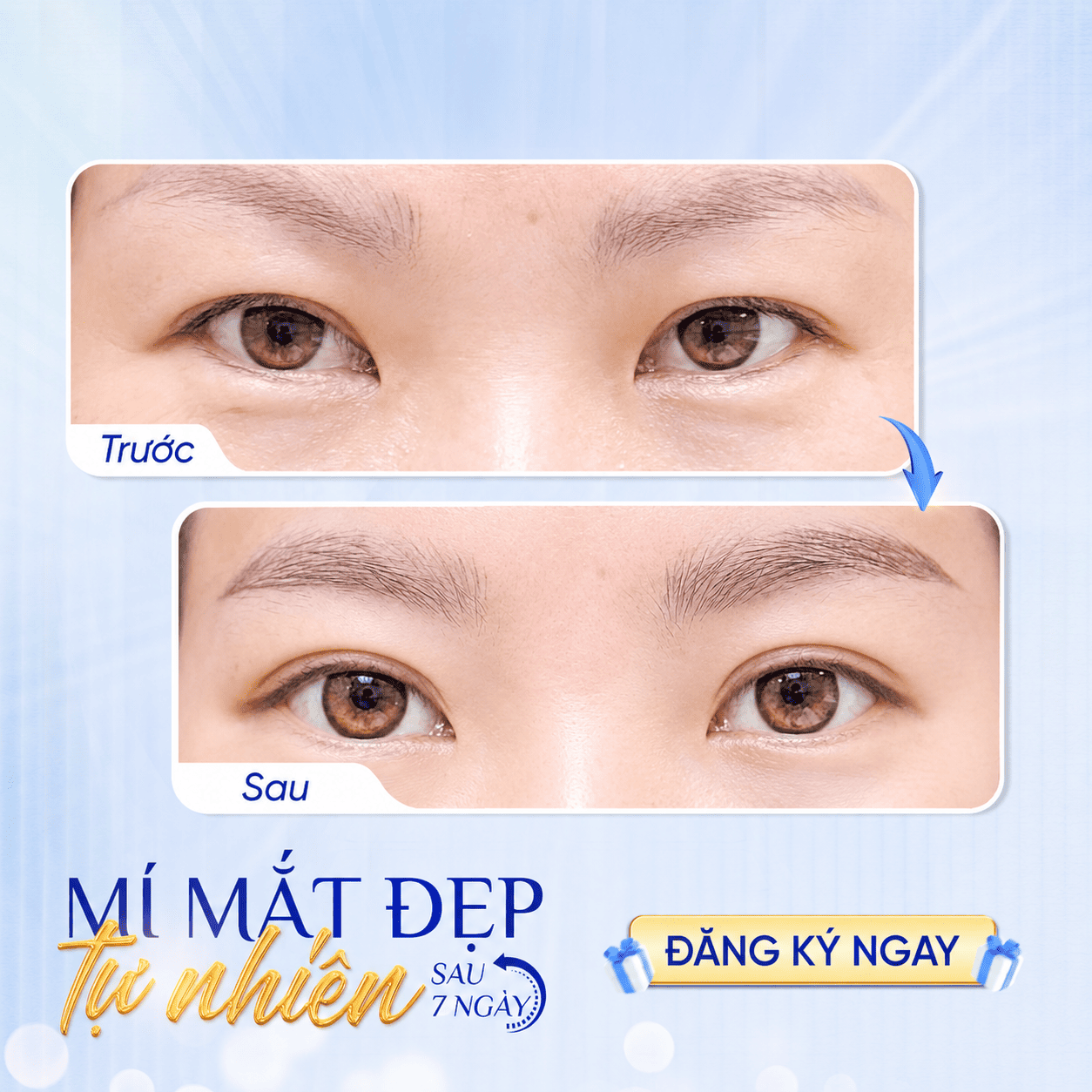 Dịch vụ cắt mí uy tín tại Hải Phòng