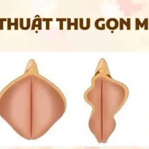 Thẩm mỹ Vùng kín - Cắt "cô bé: - Thu hẹp âm đạo