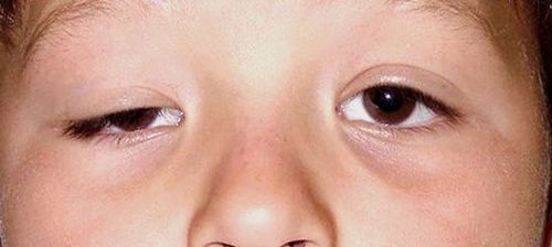 Điều trị sụp mi bẩm sinh tại Hải Phòng