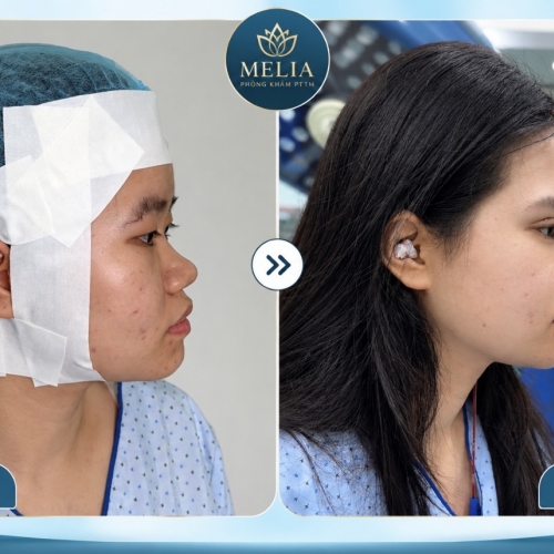 Phẫu thuật thẩm mỹ tại Hải Phòng – Hình ảnh khách hàng trước và sau
