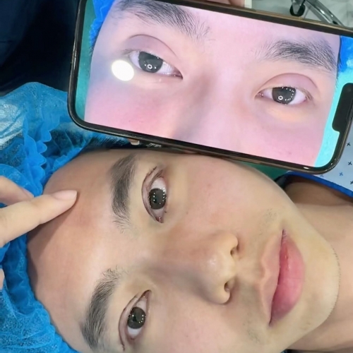 Sửa mí