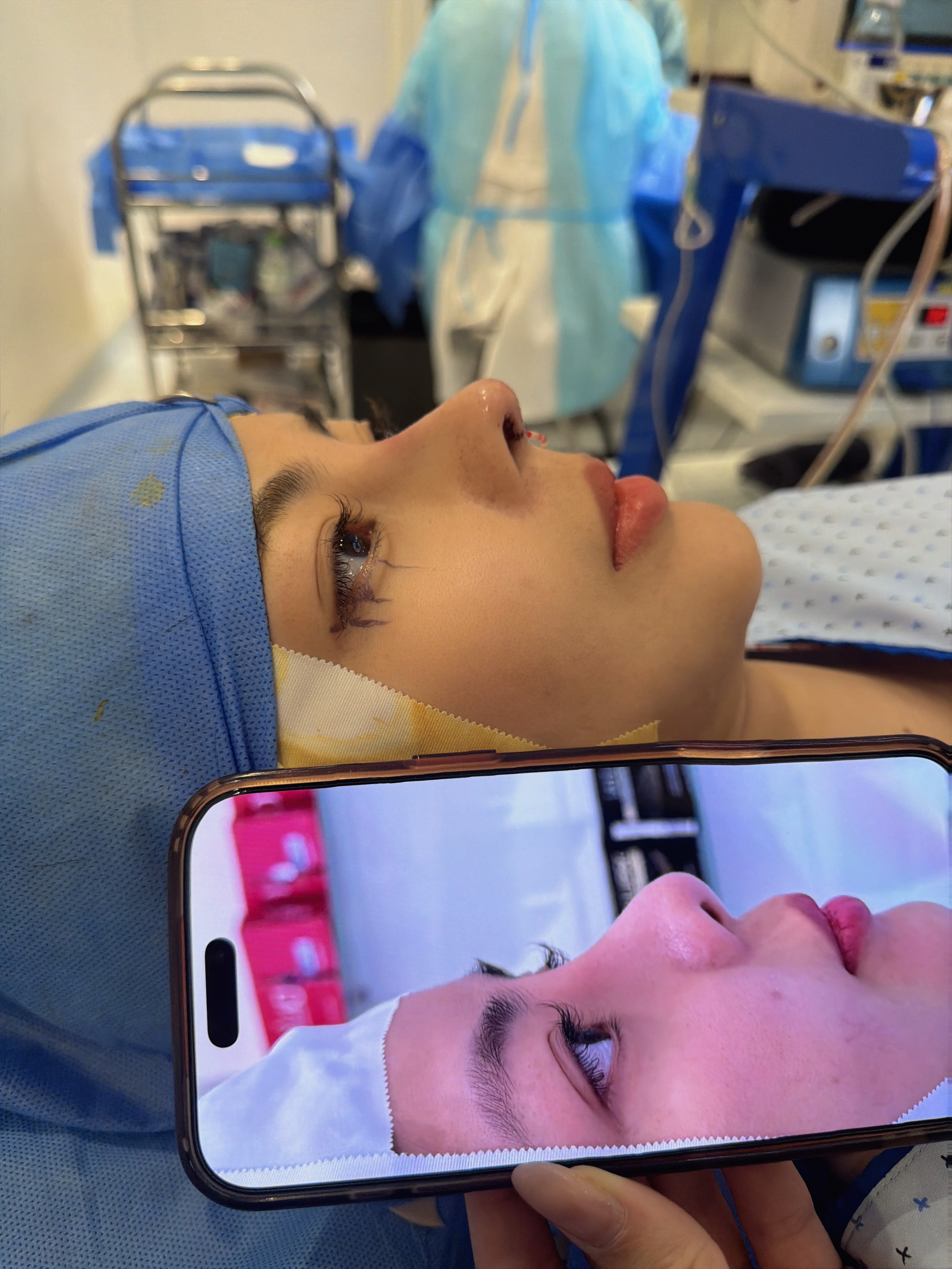 Nâng Mũi Cấu Trúc