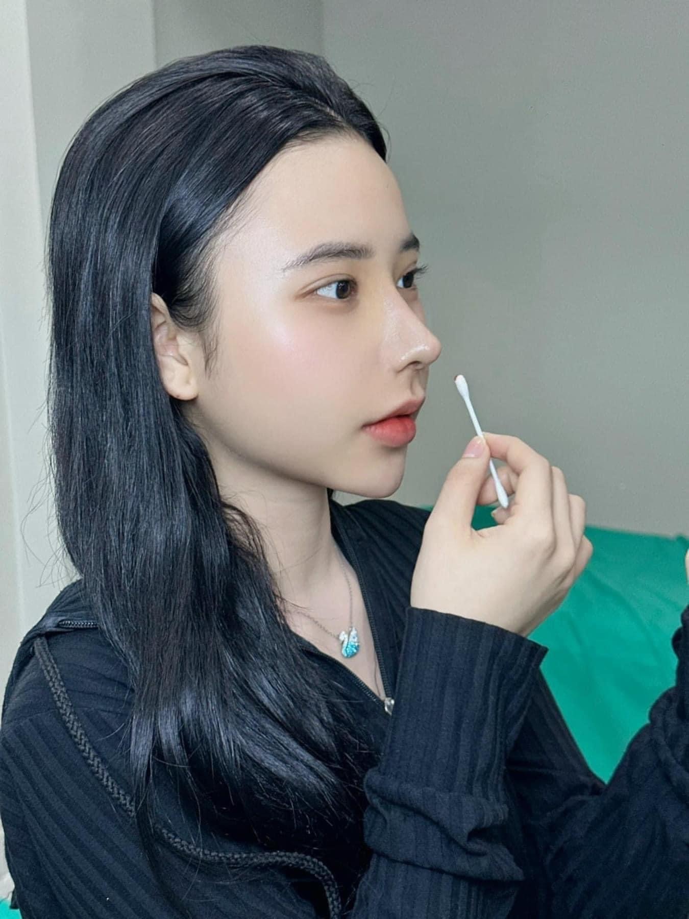 Nâng mũi cấu trúc đa tầng