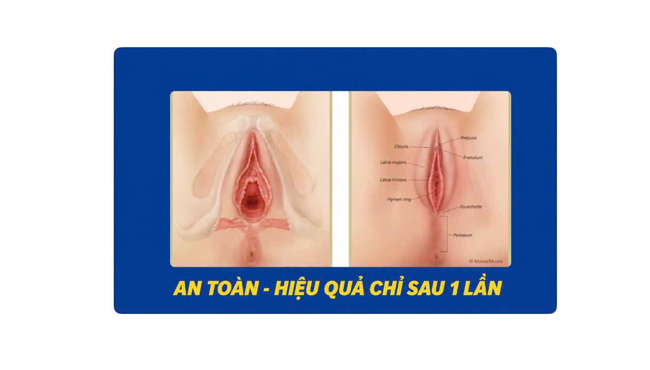 Thu hẹp âm đạo