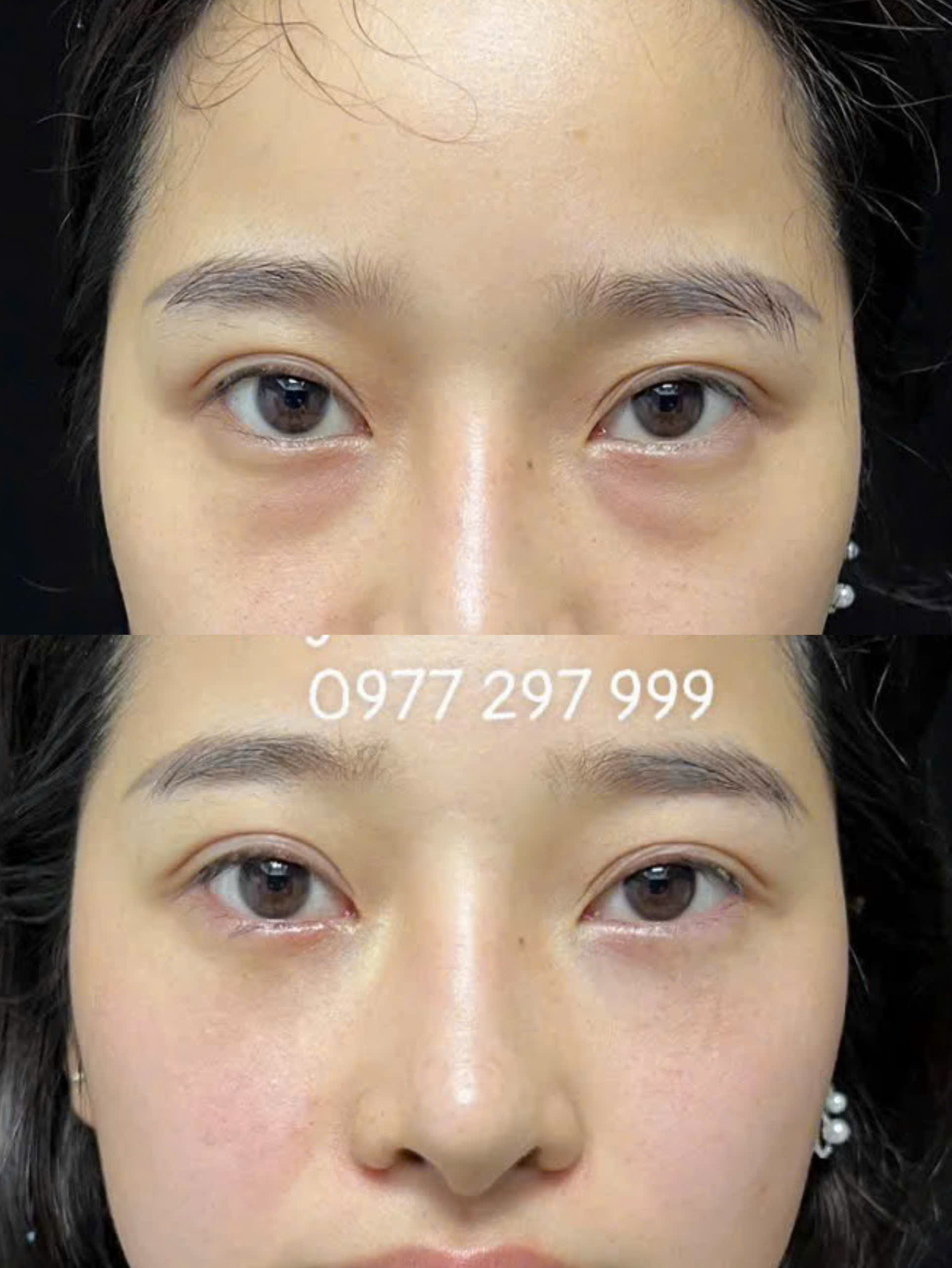 Cắt mí dưới 