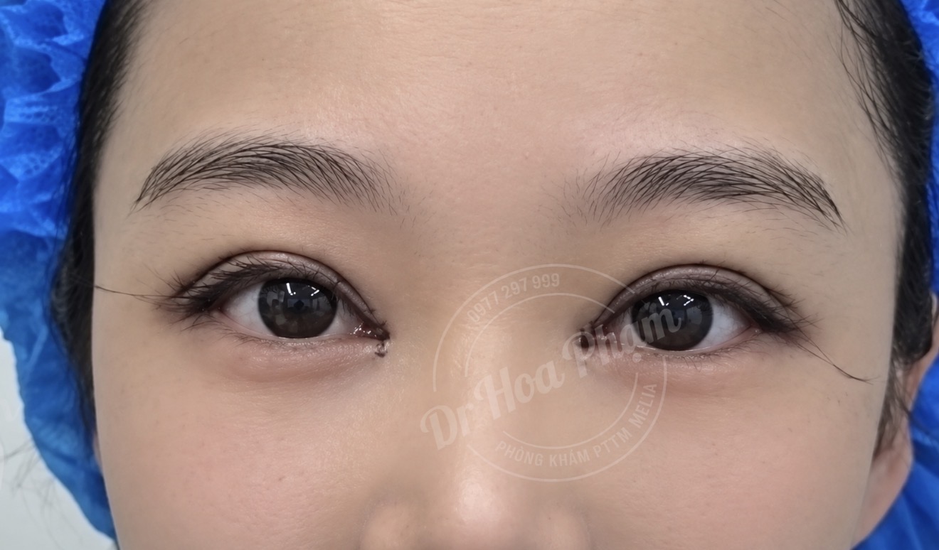 Mở Góc Mắt Ngoài